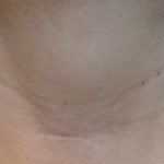 Cicatriz de incisão minimamente invasiva na prega cervical média para tireoidectomia total (3,0cm) .