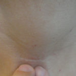 Cicatriz de incisão minimamente invasiva na prega cervical média para tireoidectomia total (3,0cm) .