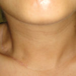 Esvaziamento cervical lateral unilateral níveis II, III, IV e V, com incisão horizontal na prega cervical inferior direita, para neoplasia de tireoide com metástase lateral.