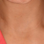 Esvaziamento cervical bilateral níveis II, III, IV e V, com incisão horizontal na prega cervical inferior, para neoplasia de tireoide com metástase lateral bilateral.